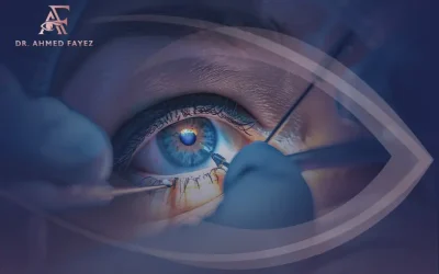 عملية الليزر السطحي