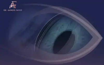 تكلفة عملية زرع القرنية في مصر