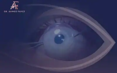 عملية زراعة القرنية