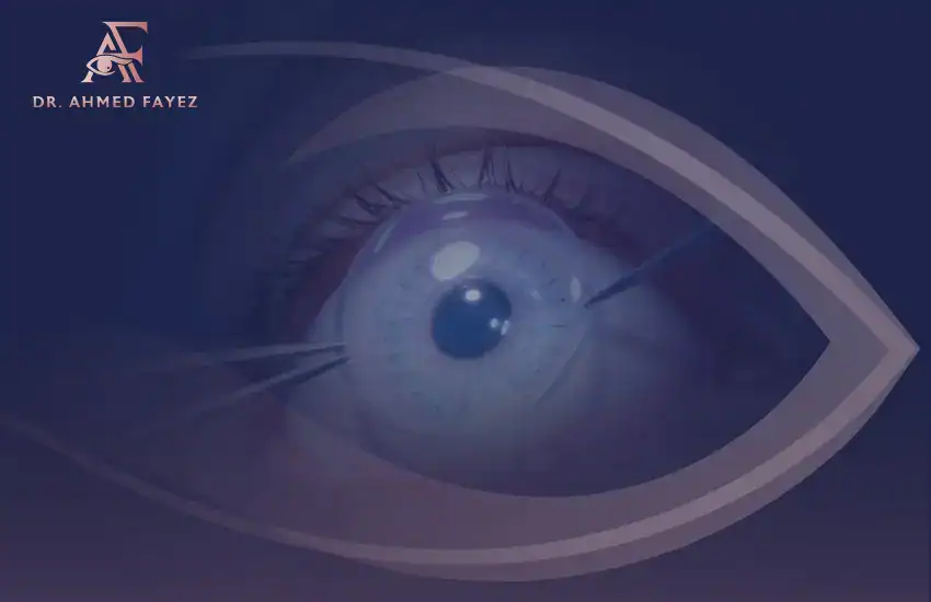 عملية زراعة القرنية