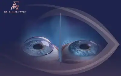 ما الفرق بين ترقيع القرنية وزراعة القرنية؟
